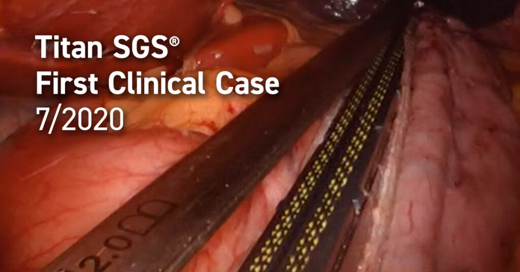 Titan SGS First Clinical Case 7-2020