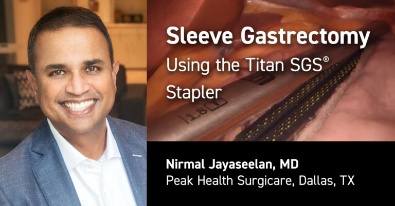 Nirmal Jayaseelan - Sleeve Gastrectomy Using Titan SGS Stapler ...